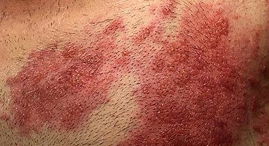 Covid-19 salgını sonrası viral hastalıklar coştu: Kızamık ve Zona'ya dikkat