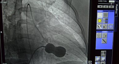 Alanya'da mitral kapak darlığı ameliyatsız tedavi edildi