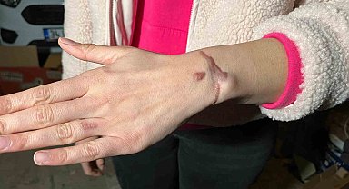 Esenyurt'ta güzellik merkezinde dövme sildirme işlemi yaptıran kadın: "Kolumu yaktılar"